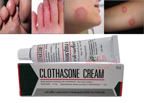 Clothasone Cream Antifungal Corticosteroid For Tinea Ringworm Athletes