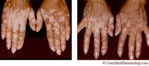 Crutchfield Dermatology Treatment Vitiligo In Minnesota