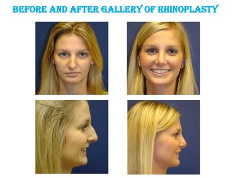 Ppt Rhinoplasty Or Nose Surgery By Dr Gregory Casey Powerpoint
