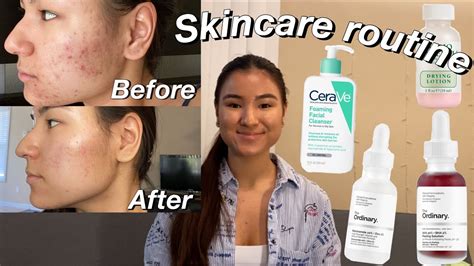 How To Get Rid Of Acne And Textured Skin Skincare Routine 2020 Youtube