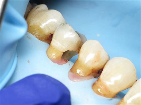 A Method To Restore Root Caries Greater Curve