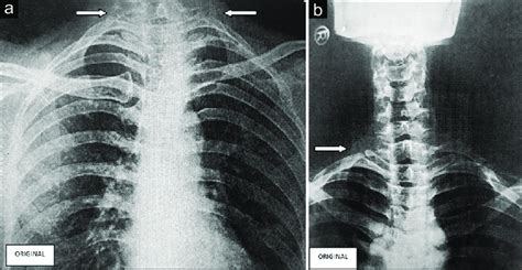 X Ray Chest Depicting Bilateral Cervical Rib A And Complete
