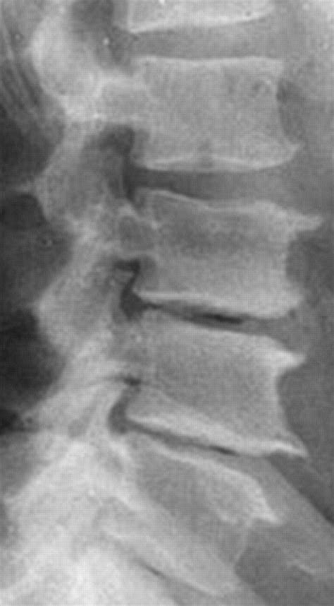 Learn how the procedure is performed and if there are any safety risks. 17 Best images about X-Ray Lumbar on Pinterest | Addiction ...