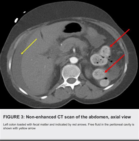 Contrast Enhanced Ct Scan Of The Abdomen Composite View A Shows The