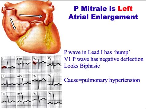 Left And Right Atrial Enlargment