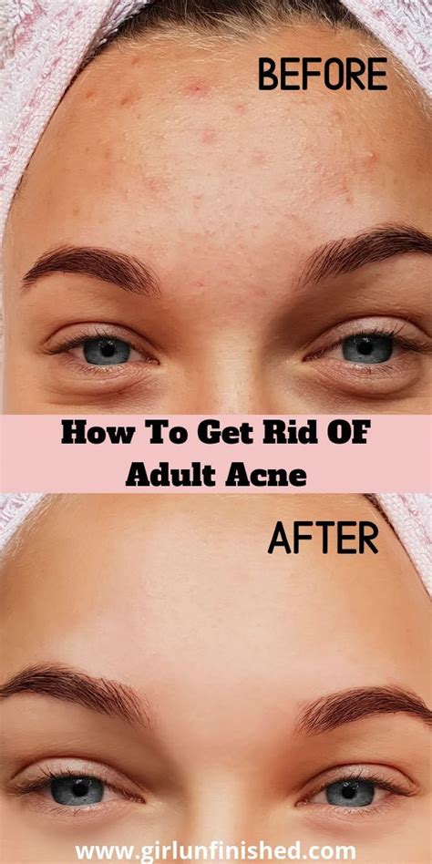 Getting Rid Of Adult Acne A Beginners Guide Best Acne Treatment