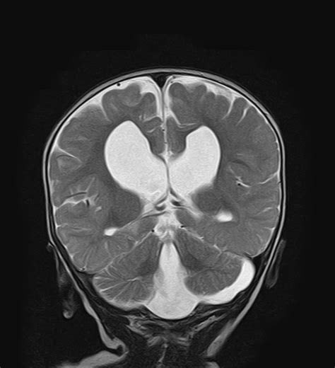 Dandy Walker Malformation With Dysgenesis Of The Corpus Callosum And