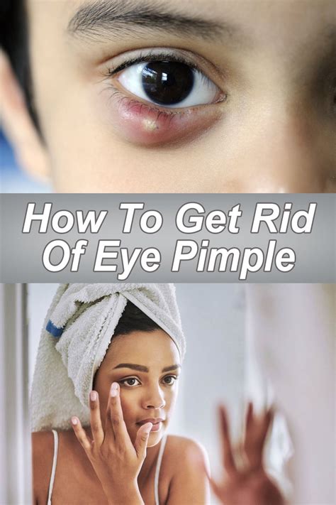 How To Get Rid Of Eye Pimple Pimples Common Eye Problems How To Get Rid