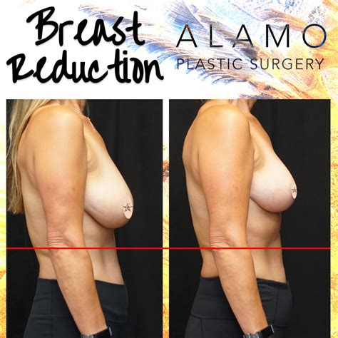 Breast Lift San Antonio Voted 1 Best Plastic Surgeon