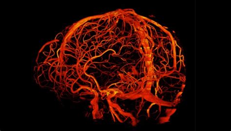 Mri Scan Of Blood Vessels In The Brain