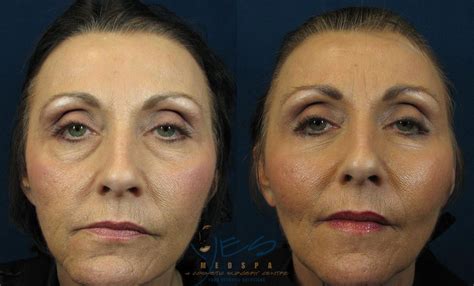 lower eyelid surgery blepharoplasty before and after photos my xxx hot girl