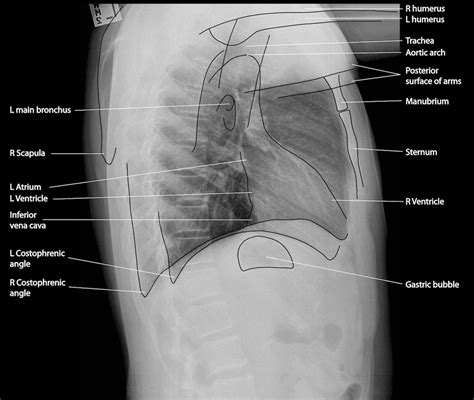 Lateral Chest Xray Anatomy