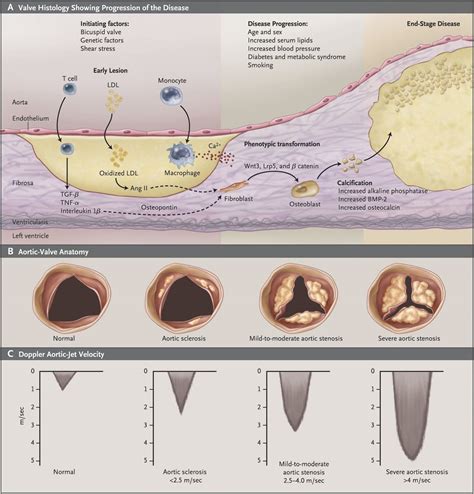 Degenerative Calcific Aortic Stenosis A Natural History Heart