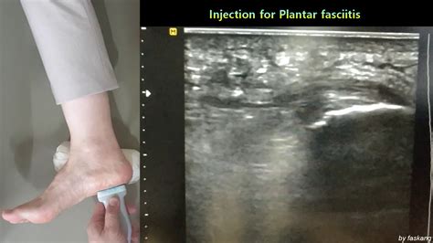137의사용dx And Tx Under Us Injection Therapy For Plantar Fasciitis