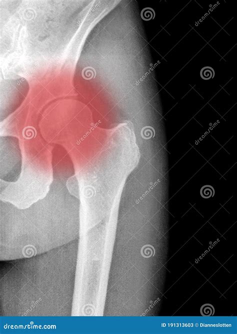 X Ray Of An Inflamed Arthritic Hip Joint In Black White And Red Stock
