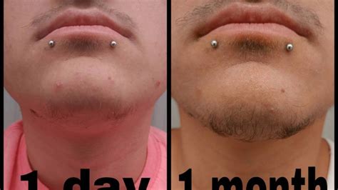 Here are some minoxidil beard before and after results! One month minoxidil beard - BeardStylesHQ