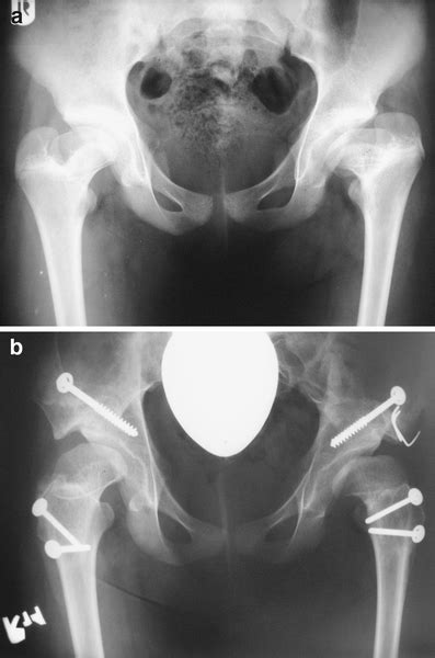 Chiari Pelvic Osteotomy In The Treatment Of Adolescent Hip Disorders