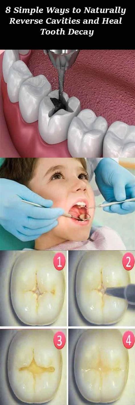 Cavities will need to be. how #to #heal #a #cavity #without #fillings - I couldn't ...