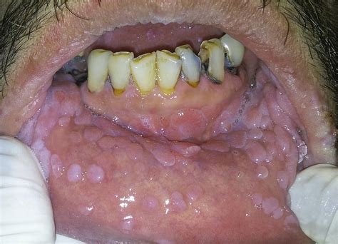 Scielo Brasil Unusual Presentation Of A Disseminated Oral Hpv Infection After Combined