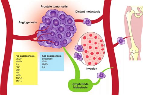 The Role Of Angiogenesis In Tumor Progression Post Natal Angiogenesis