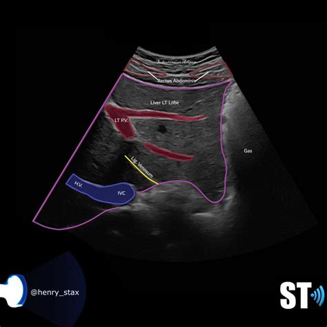 Liver Anatomy And Protocol Basics Sonographic Tendencies Ultrasound