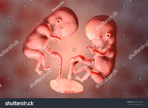 Monozygotic Twins Uterus Single Placenta Medically Stock Illustration