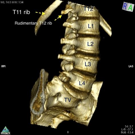 Sacralization Of L5 Radiology Case Radiopaedia Org