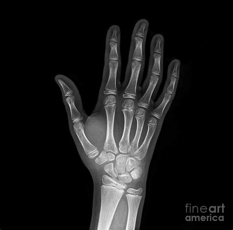 Broken Wrist Bone X Ray Photograph By Science Photo Library Pixels