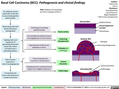 Basal Cell Carcinoma Diagram