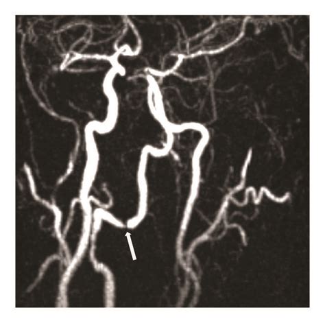 Magnetic Resonance Images Of The Affected Arteries High Grade Stenosis