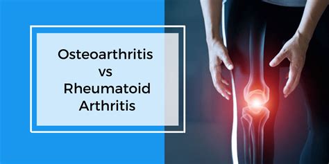 Osteoarthritis Vs Rheumatoid Arthritis Comparing The Two