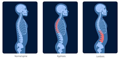 Lordosis Vs Kyphosis Unraveling The Differences In Spinal Curvature