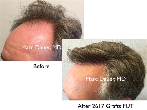 Hair Transplant Results Marc Dauer Md Hair Transplant Doctor Los Angeles