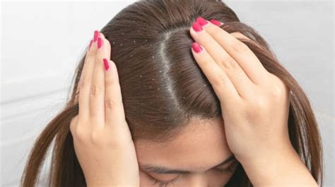 Mengenal Ciri Ciri Kutu Rambut Penyebab Dan Cara Menghilangkannya