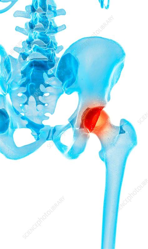 Human Hip Pain Stock Image F0163358 Science Photo Library