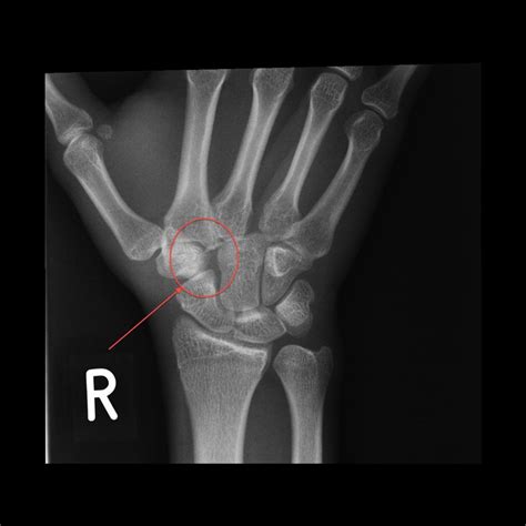 Dorsal Dislocation Of The Trapezoid With Carpo Metacarpal Dislocations