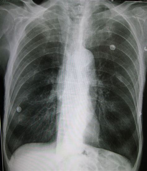 Emphysem Röntgen Des Thorax Von Ap Doccheck