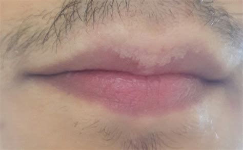 Ging dann nach ner weile. Pünktchen auf der Lippe. Normal? (Gesundheit, Arzt, Krankheit)