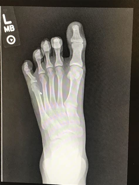 What Does A Broken Pinky Toe Look Like On X Ray Sprained