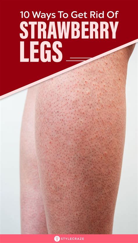 10 Natural Ways To Get Rid Of Strawberry Legs Strawberry Legs Dark