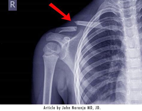 Ask Dr John Esq Clavicle Fractures During Birth Diller Law Personal