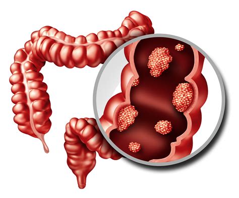 New Colorectal Cancer Biomarker Could Be Lipid Producing Enzyme
