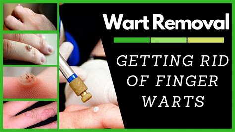 Wart Removal How To Get Rid Of Finger Warts Youtube