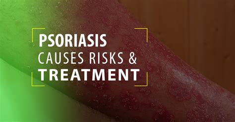 Psoriasis Causes Risks And Ayurveda Treatment Matt India Alappuzha