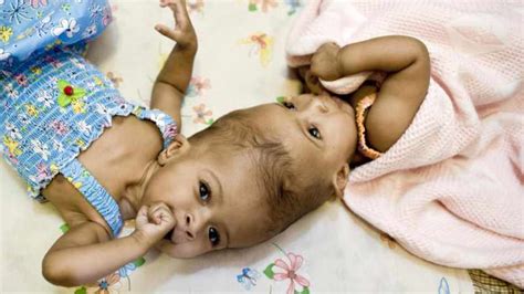 Conjoined Twin Girls Separated