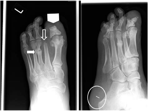 Radiograph Of Left Foot Showing Evidence Of A Healed Fracture Of The