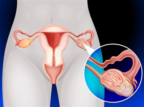 The prognosis of ovarian cancer is poor compared with other gynaecological cancers. Ovarian Cancer and Leg Pain - Her Haleness
