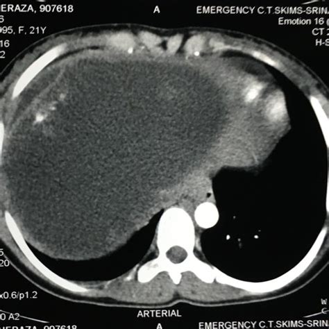 Figure3 Large Cystic Lesion In Right Lobe With Peripheral