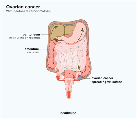 Peritoneal Carcinomatosis What Is The Link With Ovarian Cancer