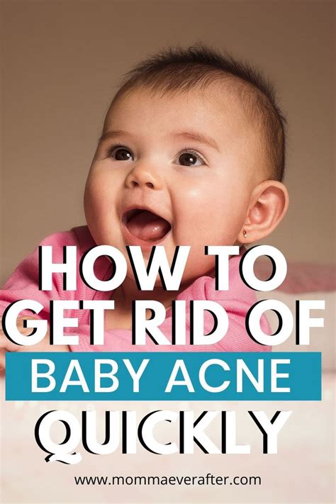 How To Get Rid Of Baby Acne An Instant Remedy The Baby Acne